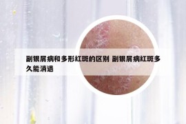 副銀屑病和多形紅斑的區(qū)別 副銀屑病紅斑多久能消退