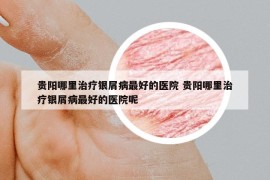 貴陽哪里治療銀屑病最好的醫(yī)院 貴陽哪里治療銀屑病最好的醫(yī)院呢