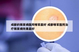 成都的銀屑病醫(yī)院哪家最好 成都哪家醫(yī)院治療銀屑病效果最好