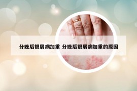 分娩后銀屑病加重 分娩后銀屑病加重的原因