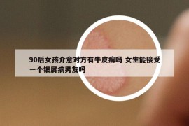 90后女孩介意對(duì)方有牛皮癬嗎 女生能接受一個(gè)銀屑病男友嗎