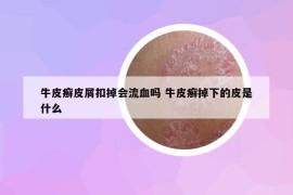 牛皮癬皮屑扣掉會(huì)流血嗎 牛皮癬掉下的皮是什么