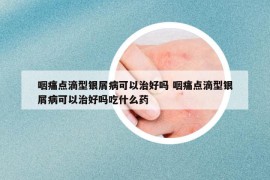 咽痛點滴型銀屑病可以治好嗎 咽痛點滴型銀屑病可以治好嗎吃什么藥
