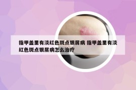 指甲蓋里有淡紅色斑點銀屑病 指甲蓋里有淡紅色斑點銀屑病怎么治療