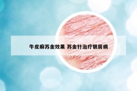 牛皮癬蘇金效果 蘇金針治療銀屑病
