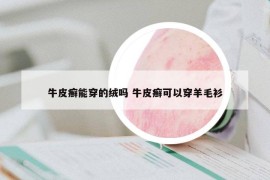 牛皮癬能穿的絨嗎 牛皮癬可以穿羊毛衫