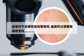 戒煙對(duì)牛皮癬恢復(fù)有幫助嗎 戒煙可以使銀屑病康復(fù)嗎
