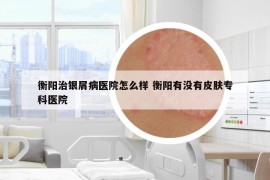 衡陽治銀屑病醫(yī)院怎么樣 衡陽有沒有皮膚?？漆t(yī)院
