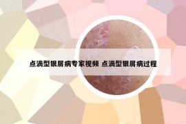 點(diǎn)滴型銀屑病專(zhuān)家視頻 點(diǎn)滴型銀屑病過(guò)程