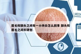 眉毛和額頭之間有一小塊白怎么回事 額頭和眉毛之間長(zhǎng)硬包