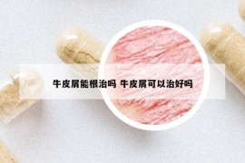 牛皮屑能根治嗎 牛皮屑可以治好嗎
