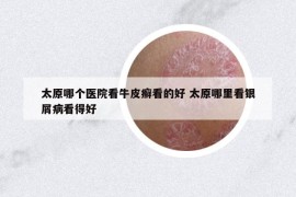 太原哪個醫(yī)院看牛皮癬看的好 太原哪里看銀屑病看得好