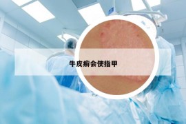 牛皮癬會(huì)使指甲