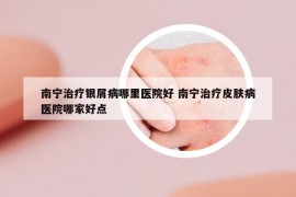 南寧治療銀屑病哪里醫(yī)院好 南寧治療皮膚病醫(yī)院哪家好點