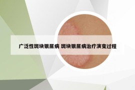 廣泛性斑塊銀屑病 斑塊銀屑病治療演變過程
