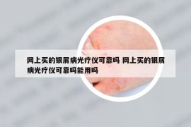 網(wǎng)上買的銀屑病光療儀可靠嗎 網(wǎng)上買的銀屑病光療儀可靠嗎能用嗎