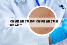 試管移植后得了銀屑病 試管移植后得了銀屑病怎么治療