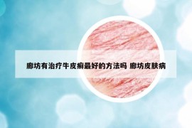 廊坊有治療牛皮癬最好的方法嗎 廊坊皮膚病