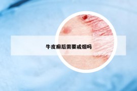 牛皮癬后需要戒煙嗎