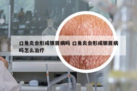 口角炎會形成銀屑病嗎 口角炎會形成銀屑病嗎怎么治療