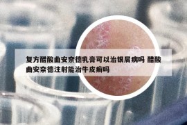 復(fù)方醋酸曲安奈德乳膏可以治銀屑病嗎 醋酸曲安奈德注射能治牛皮癬嗎