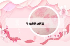 牛皮癬天熱厲害