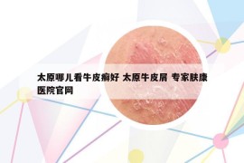 太原哪兒看牛皮癬好 太原牛皮屑 專家膚康醫(yī)院官網(wǎng)