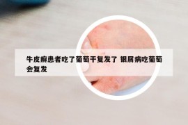 牛皮癬患者吃了葡萄干復發(fā)了 銀屑病吃葡萄會復發(fā)