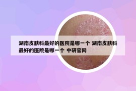 湖南皮膚科最好的醫(yī)院是哪一個 湖南皮膚科最好的醫(yī)院是哪一個 中研官網(wǎng)