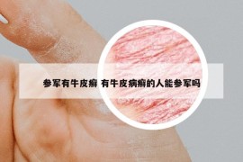 參軍有牛皮癬 有牛皮病癬的人能參軍嗎