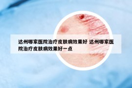 達州哪家醫(yī)院治療皮膚病效果好 達州哪家醫(yī)院治療皮膚病效果好一點