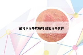 醋可以治牛皮癬嗎 醋能治牛皮鮮