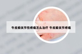牛皮癬關(guān)節(jié)性疼痛怎么治療 牛皮廨關(guān)節(jié)疼痛