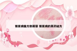 銀屑病偏方刺蒺藜 銀屑病的草藥秘方