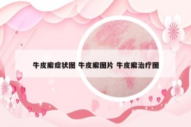 牛皮廨癥狀圖 牛皮廨圖片 牛皮廨治療圖