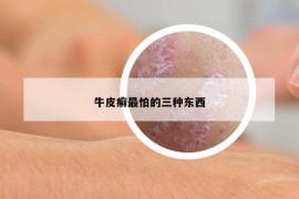 牛皮癬最怕的三種東西