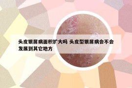 頭皮銀屑病面積擴大嗎 頭皮型銀屑病會不會發(fā)展到其它地方