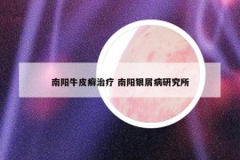 南陽牛皮癬治療 南陽銀屑病研究所