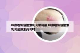 咪康唑氯倍他索乳膏銀屑病 咪康唑氯倍他索乳膏是激素藥膏嗎