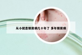 從小就患銀屑病幾十年了 多年銀屑病