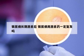 銀屑病長期激素后 銀屑病用激素藥一定復(fù)發(fā)嗎