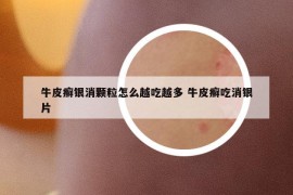 牛皮癬銀消顆粒怎么越吃越多 牛皮癬吃消銀片