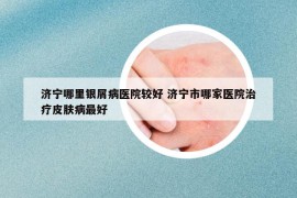 濟寧哪里銀屑病醫(yī)院較好 濟寧市哪家醫(yī)院治療皮膚病最好