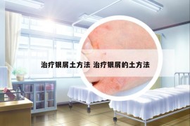 治療銀屑土方法 治療銀屑的土方法