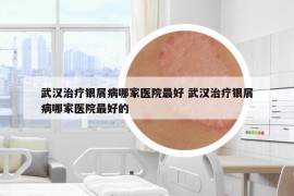 武漢治療銀屑病哪家醫(yī)院最好 武漢治療銀屑病哪家醫(yī)院最好的
