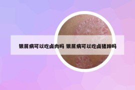 銀屑病可以吃鹵肉嗎 銀屑病可以吃鹵豬蹄嗎