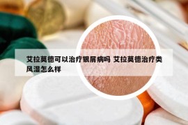 艾拉莫德可以治療銀屑病嗎 艾拉莫德治療類風(fēng)濕怎么樣