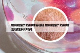 銀屑病紫外線照射活動期 銀屑病紫外線照射活動期多長時間
