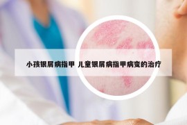 小孩銀屑病指甲 兒童銀屑病指甲病變的治療