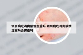 銀屑病吃雞肉病情加重嗎 銀屑病吃雞肉病情加重嗎會傳染嗎